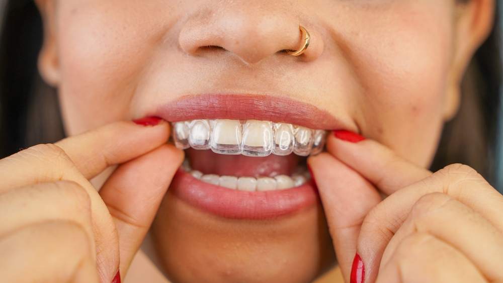Invisalign in Baton Rouge, LA. Dr. Bobby Nguyen. WN Dental