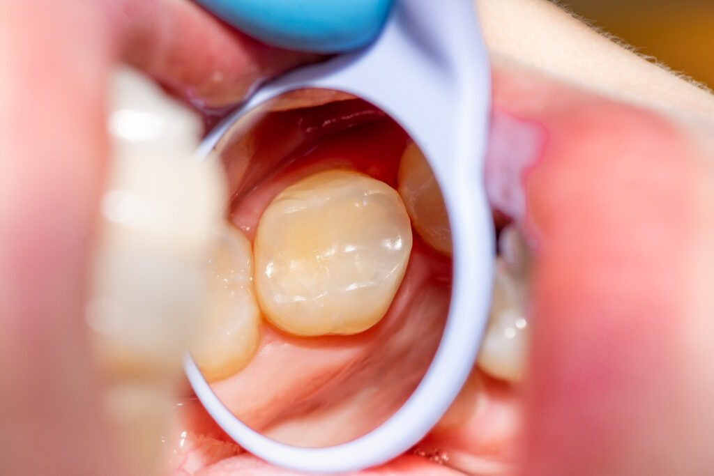 Dental Fillings in Baton Rouge